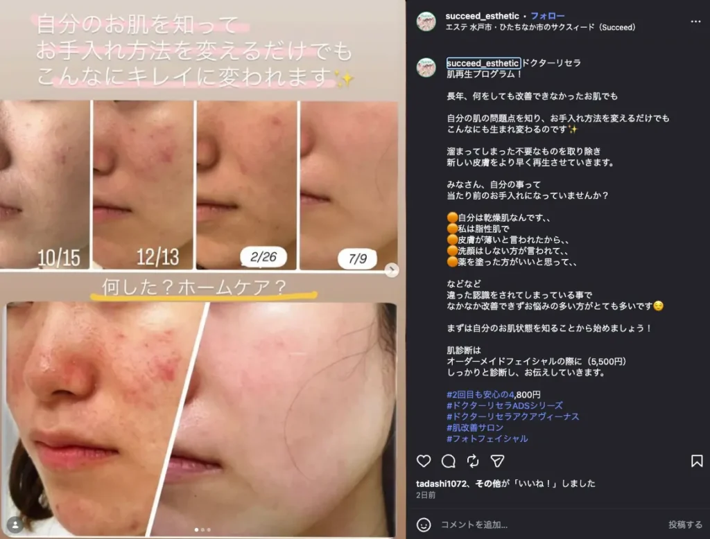 水戸のエステ「サクスィード」での肌ケアの経過を撮影した写真