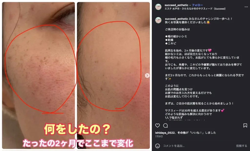 サクスィードで肌ケアを始める前と2か月後の頬の経過写真