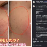 サクスィードで肌ケアを始める前と2か月後の頬の経過写真