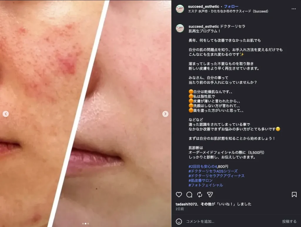 頬の赤みが改善したビフォー・アフターの写真