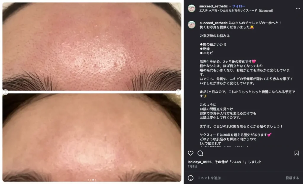 おでこの肌ケア開始前と2か月後の経過写真