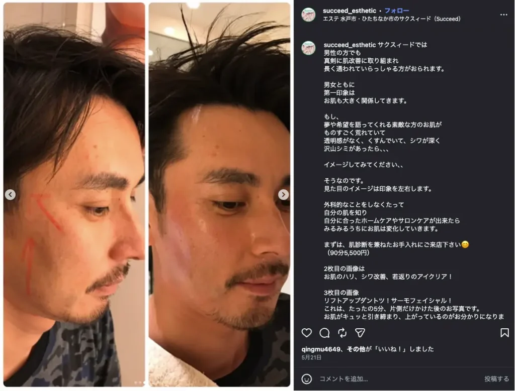 サーモフェイシャル(サーモ・シェイプDEEP)による男性のリフトアップ施術前後の比較写真