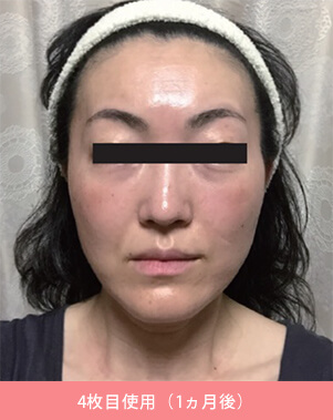 シード ウィークリーステムリッチマスクの1ヶ月使用後の写真（40代女性）