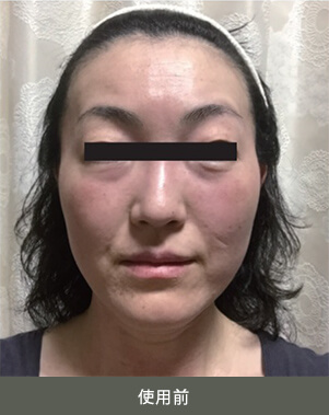 シード ウィークリーステムリッチマスクの使用前の写真（40代女性）