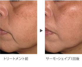 45歳・女性の顎部、耳下への施術ビフォーアフター写真