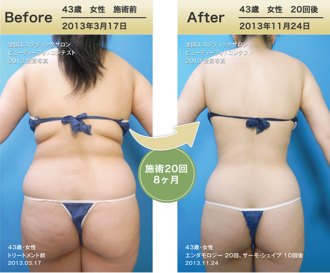 43歳女性　Before・After症例集