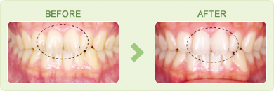 歯のホワイトニングのビフォーアフター写真