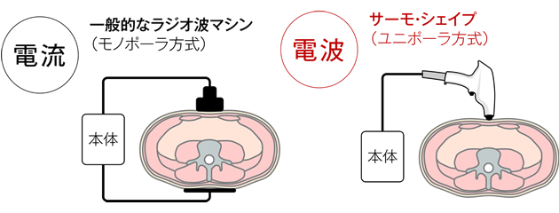 一般的なラジオ波マシンとサーモシェイプの違い解説図